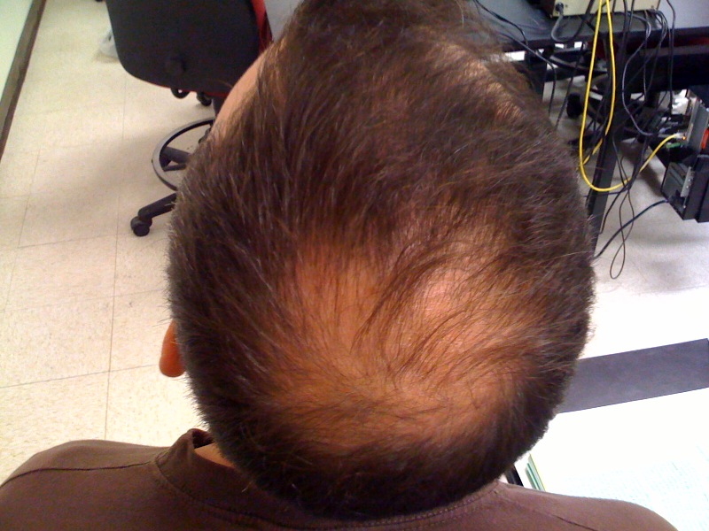 Male Pattern Baldness | Hair Loss Men - Universal Hair Clinic Dublin Male Pattern Baldness | Hair Loss Men - Universal Hair Clinic Dublin
