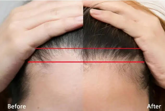 Before After Hair Loss Regrowth