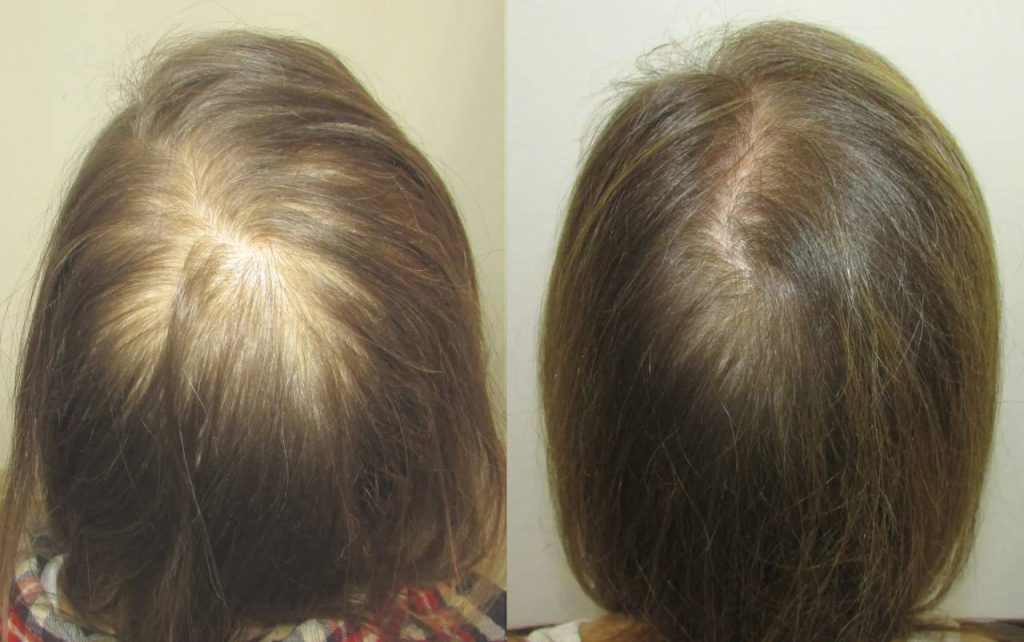 Patricia Hair Recovery Before-After